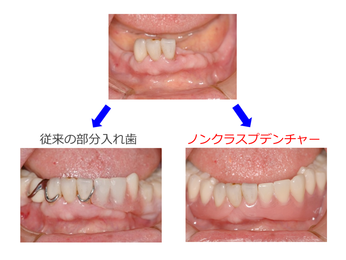 入れ歯 部分